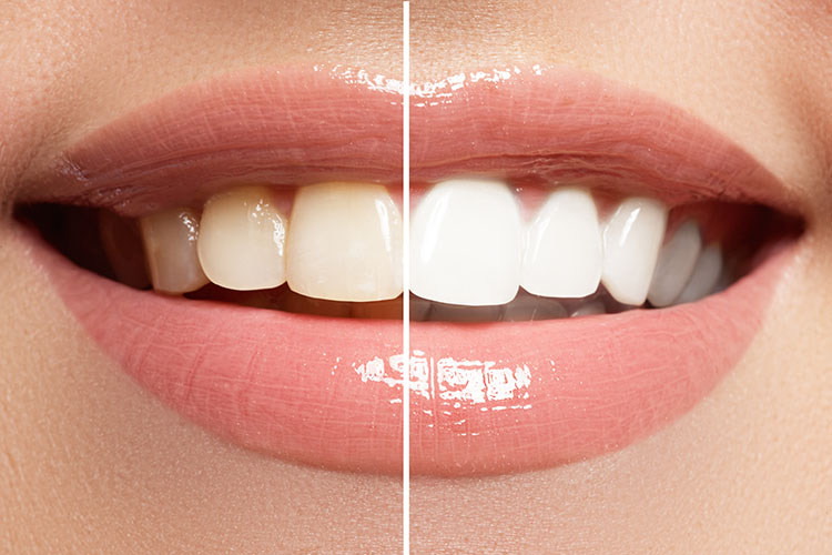 Zahnaufhellung / Bleaching
