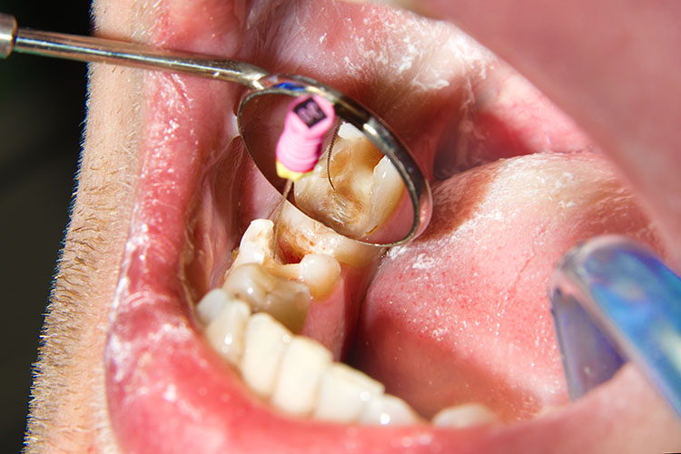 Wurzelbehandlungen / Endodontie